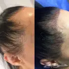 اخصائيه اكستنشن حواجب و مايكرو هير لاخفاء فراغات الشعر