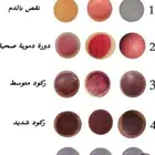 الشفاء للحجامة  التداوي بالمسنونة