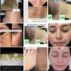 كريم تفتيح البشره تصبغات اثرات حبوب هالات سوداء