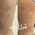 للتخلص من الصدفيه والاكزيما