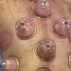 الحجامة النبوية