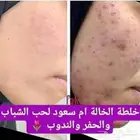 كريمات تبييض وتفتيح اماكن حساسة مضمونه 100