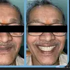 طقم اسنان كامل علوي وسفلي