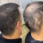 استعد م ضاع منك من نضاره بشره الي تساقط شعرك