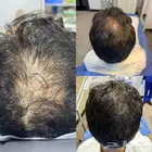 تبغى حل لتساقط الشعر والفراغات الخل عندى حياك راسلني خاص