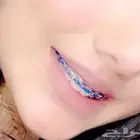 تقويم أسنان زينه