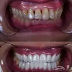 تركيبات اسنان تلبيس اسنان ابتسامة هوليوود زراعة اسنان