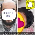 لصق شعر طبيعي دائم حل للصلع