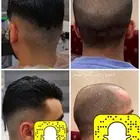 بوستيجه للصلع دائمة