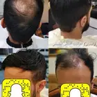 تركيب شعر طبيعي رجالي بديل الزراعة