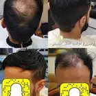 تركيب شعر طبيعي بوستيجة