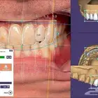 برنامج تصميم الاسنان - اكزوكاد Exocad بمناسبة العيد 100 ريال