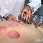 حجامة احترافية لتخفيف آلامك وزيادة طاقتك