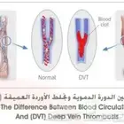 جهاز مانع تجلطات الدم في الأقدام