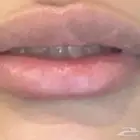 قبل تفتيح وتوريد الشفايف وبعد