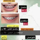 تقويم اسنان مع التركيب