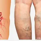 زيت دوالي الخصية والساقين