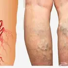 زيت دوالي الخصية والساقين