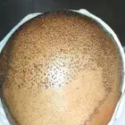 مركز رويال لزراعة الشعر بمصر