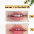 تجميل فيلر