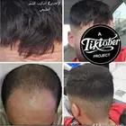 تركيب شعر للصلع