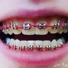 تقويم اسنان زينه 60 ريال