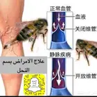 لسع اوقرص بنحل علاج الدوالي