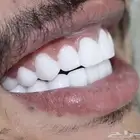 عروض على ابتسامة هوليود الفينير المتحركه اقساط