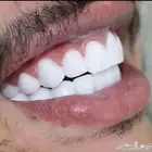 عروض على ابتسامه هوليود المتحركه سناب اون سمايل متوفر اقساط