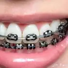 تقويم اسنان مع التركيب