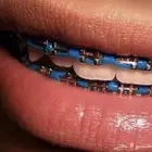 تقويم اسنان زينه 60