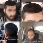 تركيب شعر دائم الرياض