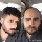باروكه لصق رجالي دائم