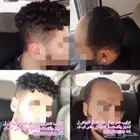 بوستيجة تركيب شعر رجالي