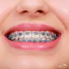 تقويم أسنان زينه